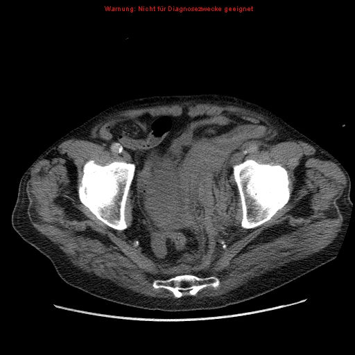 Abdominal aortic aneurysm- extremely large, ruptured (Radiopaedia 19882-19921 Axial C+ arterial phase 70).jpg