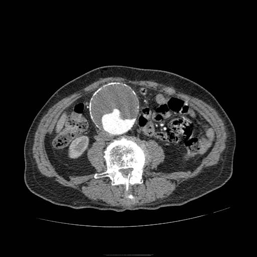 Abdominal aortic aneurysm (Radiopaedia 13341-13340 Axial C+ arterial phase 117).jpg