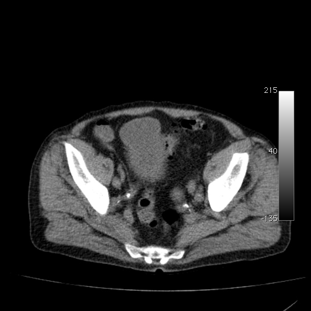 Abdominal aortic aneurysm (Radiopaedia 29248-29660 Axial non-contrast 48).jpg