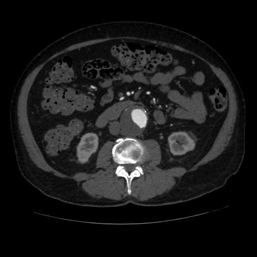File:Abdominal aortic aneurysm (Radiopaedia 57318-64259 Axial C+ arterial phase 37).jpg