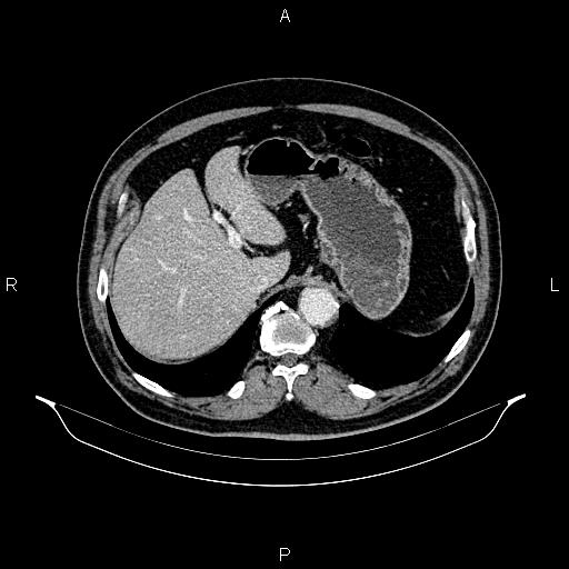 Abdominal aortic aneurysm (Radiopaedia 83094-97462 Axial renal cortical phase 72).jpg