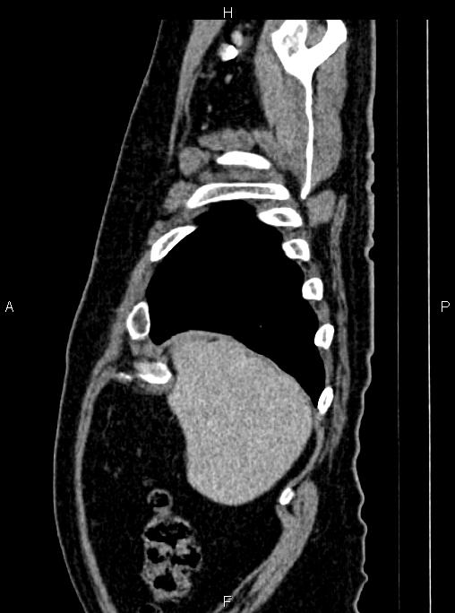 Abdominal aortic aneurysm (Radiopaedia 83094-97462 Sagittal renal cortical phase 19).jpg