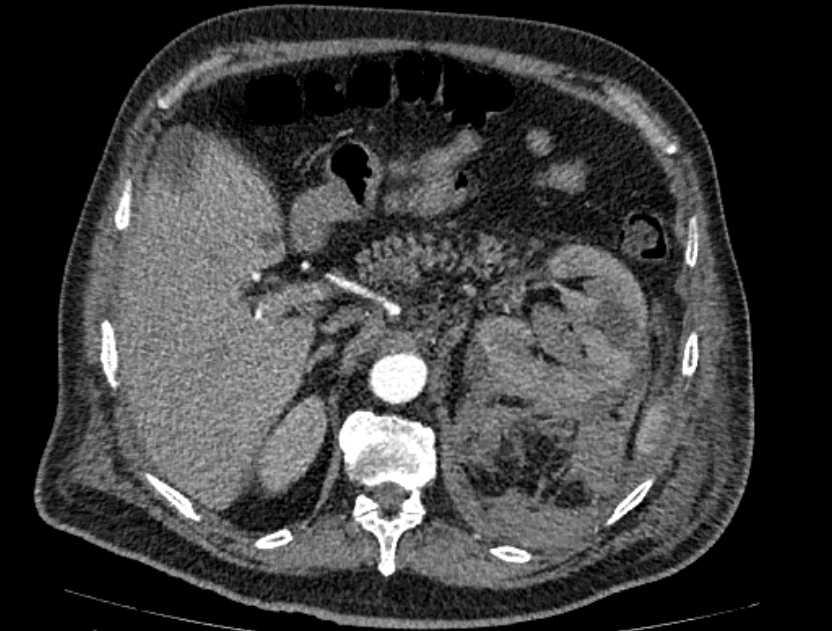 Abdominal aortic aneurysm rupture (Radiopaedia 54179-60362 Axial C+ arterial phase 24).jpg