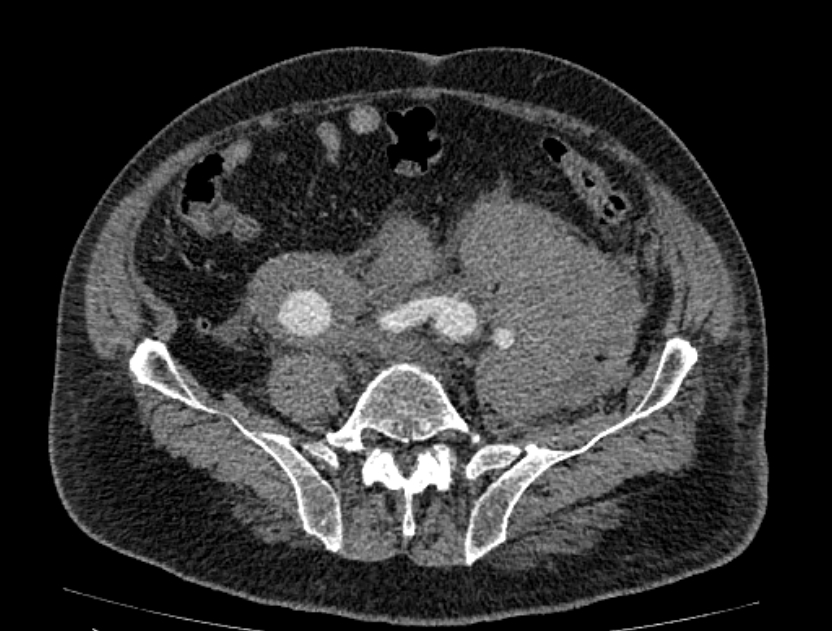 Abdominal aortic aneurysm rupture (Radiopaedia 54179-60362 Axial C+ arterial phase 42).jpg