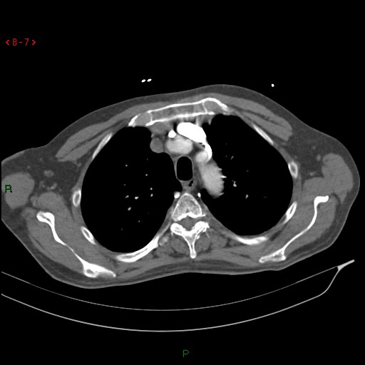 Abdominal aortic aneurysm rupture with aortocaval fistula (Radiopaedia 14897-14841 Axial C+ arterial phase 7).jpg