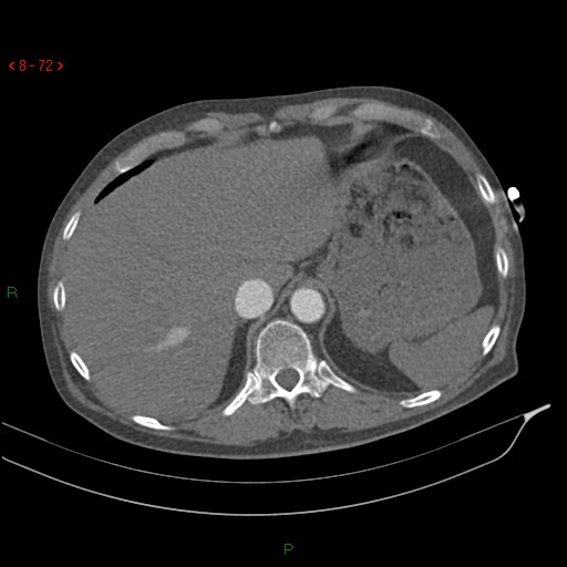 File:Abdominal aortic aneurysm rupture with aortocaval fistula (Radiopaedia 14897-14841 Axial C+ arterial phase 72).jpg