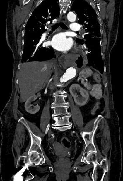 Abdominal aortic aneurysm with thrombus fissuration (Radiopaedia 73192-83919 Coronal C+ arterial phase 51).jpg