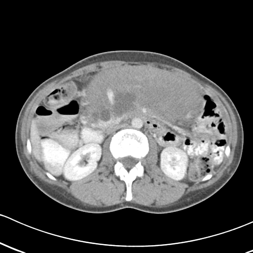 Abdominal desmoid tumor (Radiopaedia 41007-43740 Axial C+ portal venous phase 27).png