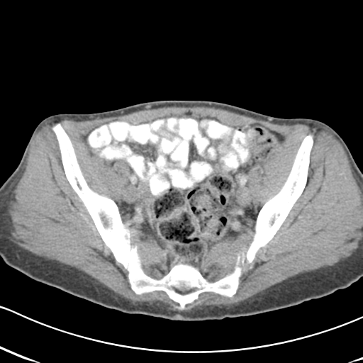 Abdominal desmoid tumor (Radiopaedia 41007-43740 Axial C+ portal venous phase 58).png