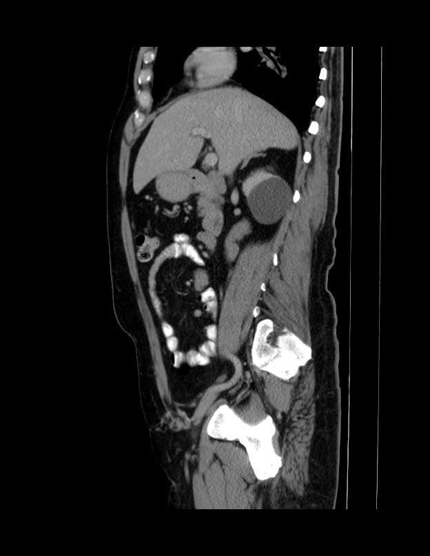 Abdominal lymphoma - with sandwich sign (Radiopaedia 53486-59492 Sagittal C+ portal venous phase 51).jpg