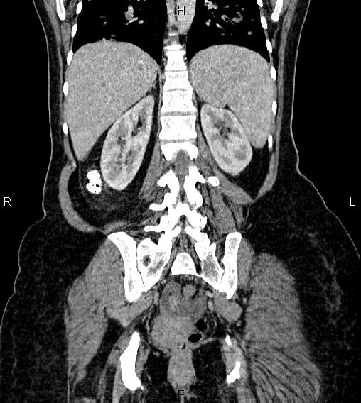 Abdominal lymphoma with sandwich sign (Radiopaedia 84378-99704 Coronal C+ portal venous phase 49).jpg