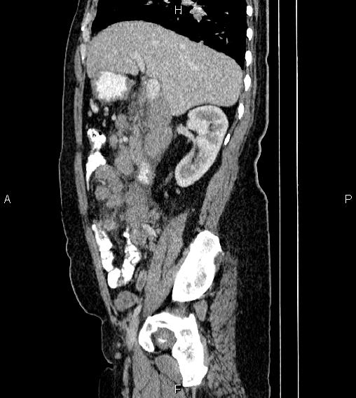 Abdominal lymphoma with sandwich sign (Radiopaedia 84378-99704 Sagittal C+ portal venous phase 27).jpg