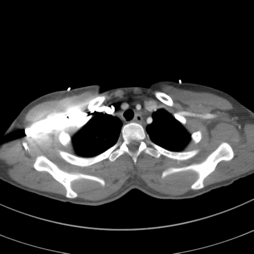 File:Abdominal multi-trauma - devascularised kidney and liver, spleen and pancreatic lacerations (Radiopaedia 34984-36486 Axial C+ arterial phase 16).png