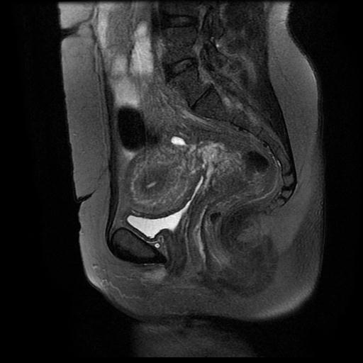 File:Abdominal wall endometriosis (Radiopaedia 83702-98847 Sagittal T2 fat sat 8).jpg