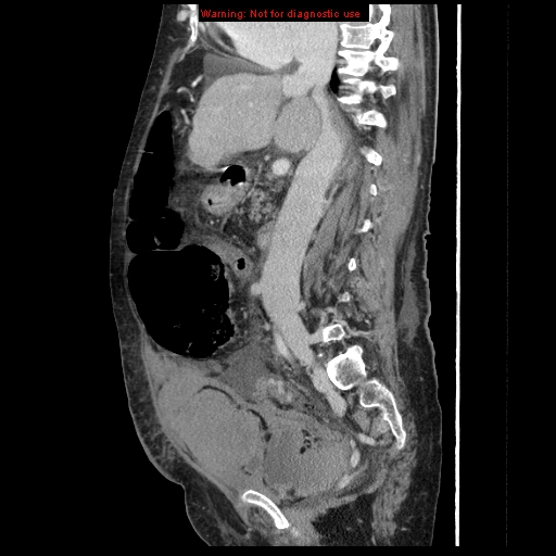 Abdominal wall hematoma (Radiopaedia 9427-10112 Sagittal C+ portal venous phase 60).jpg