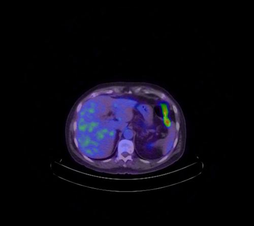 Abdominal wall metastasis from colorectal carcinoma (Radiopaedia 31016-31719 Axial 86).jpg