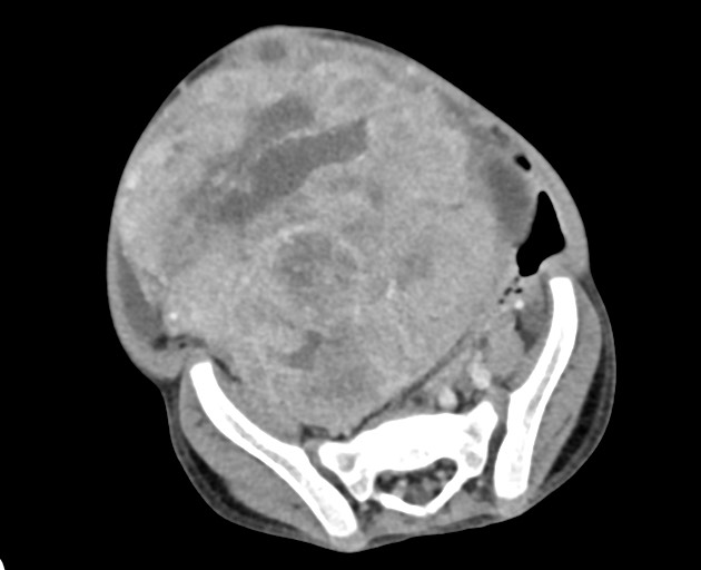 Abdominopelvic rhabdomyosarcoma (Radiopaedia 78356-90984 Axial C+ portal venous phase 125).jpg
