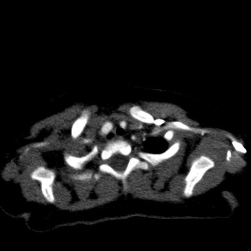 Aberrant left pulmonary artery (pulmonary sling) (Radiopaedia 42323-45435 Axial C+ CTPA 7).jpg