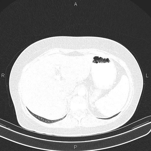 Aberrant right subclavian artery (Radiopaedia 87334-103629 Axial lung window 65).jpg