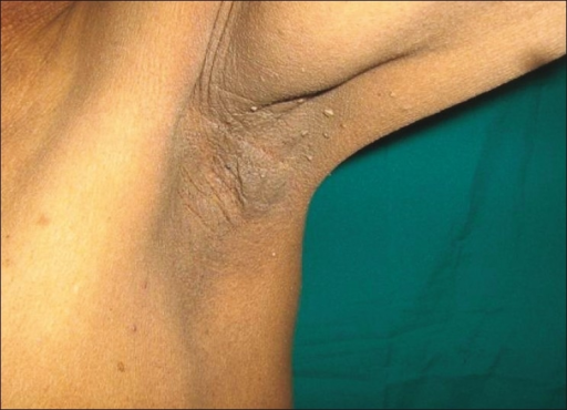 File:Acanthosis nigricans axillae and neck.png