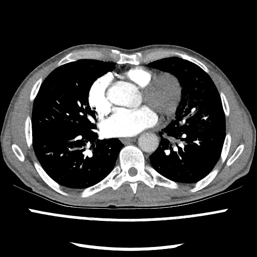 Accessory left horizontal fissure with lingular pneumonia (Radiopaedia 53763-59843 Axial C+ CTPA 56).jpg