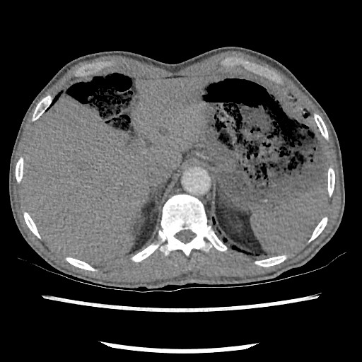Accessory left horizontal fissure with lingular pneumonia (Radiopaedia 53763-59843 Axial C+ CTPA 85).jpg
