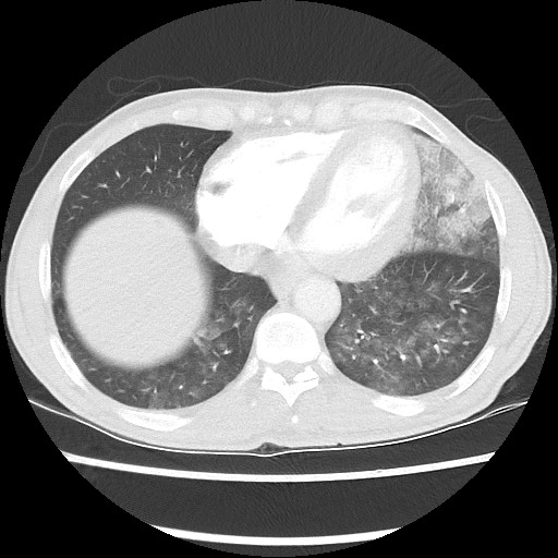 Accessory left horizontal fissure with lingular pneumonia (Radiopaedia 53763-59843 Axial lung window 42).jpg