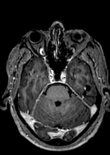Accessory middle cerebral artery (Radiopaedia 73114-83828 Axial T1 C+ 106).jpg