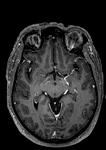 Accessory middle cerebral artery (Radiopaedia 73114-83828 Axial T1 C+ 59).jpg