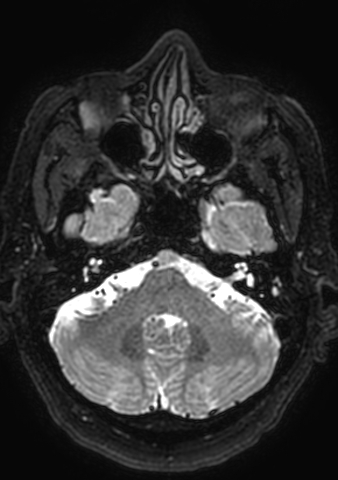 Accessory middle cerebral artery (Radiopaedia 73114-83828 Axial T2 170).jpg