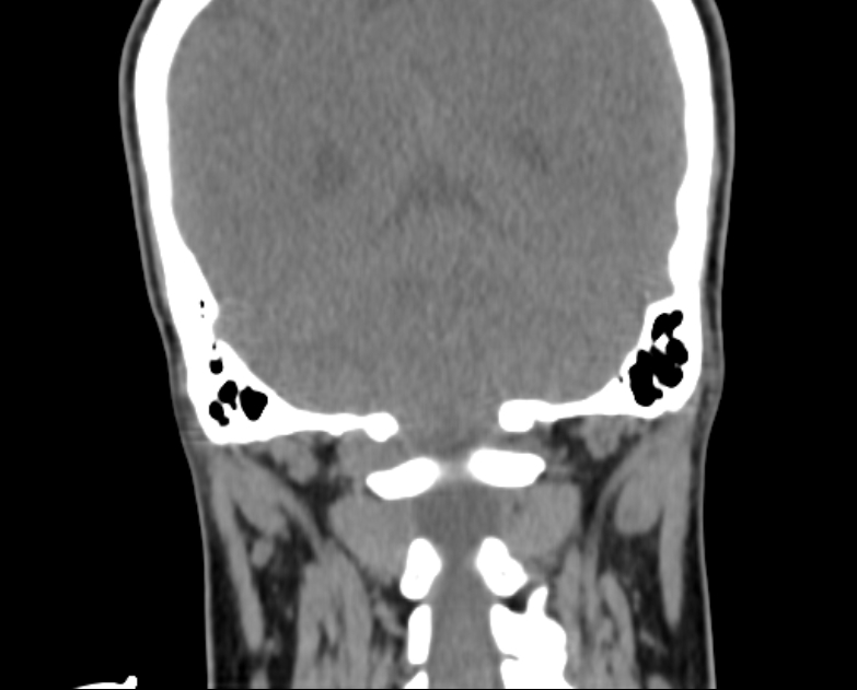 Accessory parotid gland (Radiopaedia 76207-87772 Coronal non-contrast 110).jpg