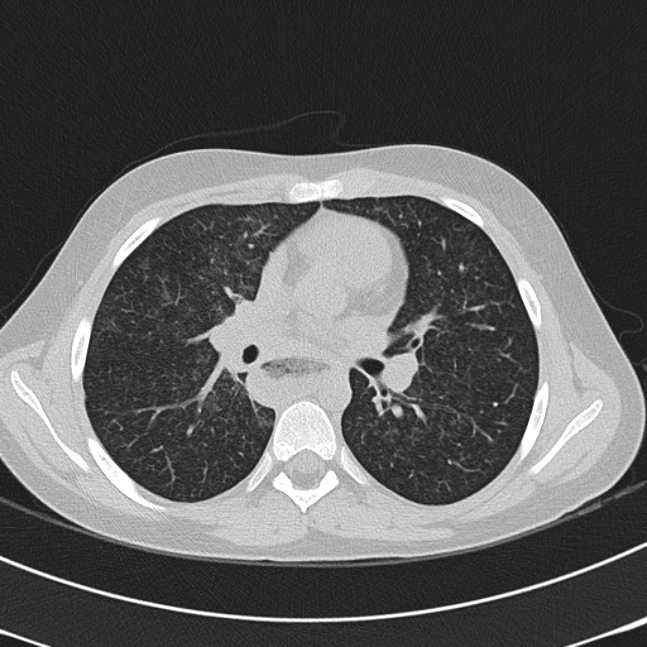 Achalasia (Radiopaedia 14946-14878 Axial lung window 35).jpg