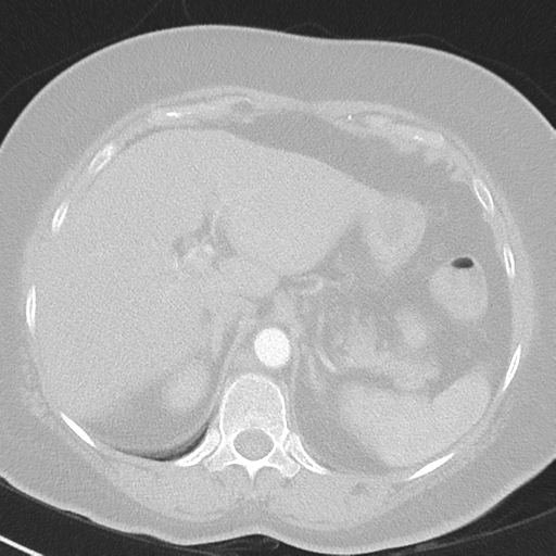 File:Achalasia (Radiopaedia 47147-51685 Axial lung window 47).png