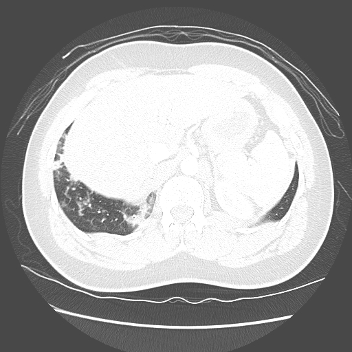 Achalasia (Radiopaedia 52507-58417 Axial lung window 59).jpg