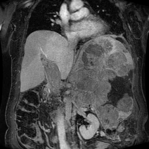 Acinar cell carcinoma of the pancreas (Radiopaedia 75442-86668 Coronal T1 C+ fat sat 102).jpg