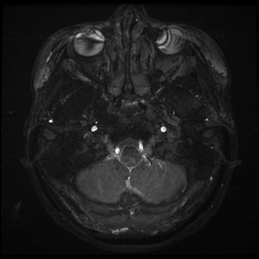 Acoustic neuroma (Radiopaedia 34049-35283 Axial 3).png