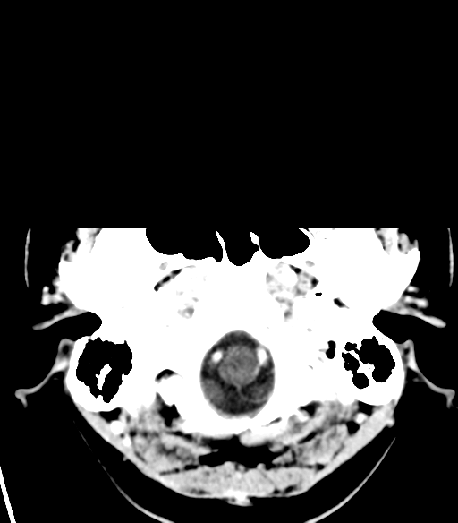 File:Acoustic schwannoma (Radiopaedia 33045-34065 Axial C+ delayed 2).png
