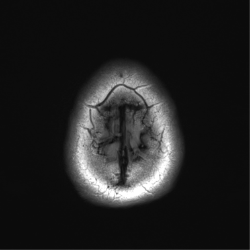 File:Acoustic schwannoma (Radiopaedia 50846-56358 Axial FLAIR 30).png