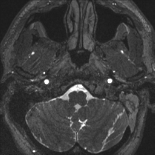 Acoustic schwannoma (translabyrinthine resection) (Radiopaedia 43570-46972 Axial CISS 6).png