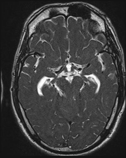 File:Acoustic schwannoma - probable (Radiopaedia 20386-20292 Axial T1 61).jpg