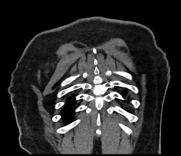 Acromioclavicular joint cyst (Radiopaedia 58455-65610 Coronal C+ arterial phase 128).jpg
