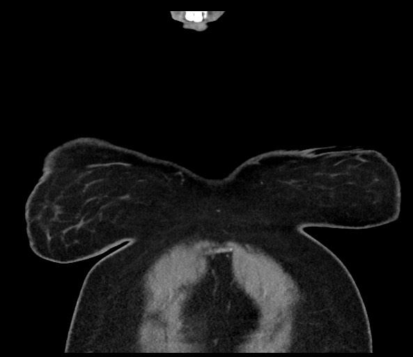 File:Acromioclavicular joint cyst (Radiopaedia 58455-65610 Coronal C+ arterial phase 18).jpg