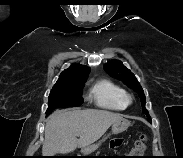 Acromioclavicular joint cyst (Radiopaedia 58455-65610 Coronal C+ arterial phase 42).jpg