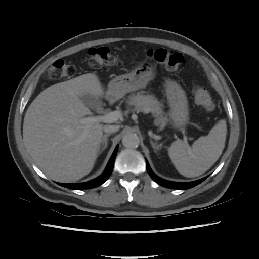 File:Active colonic bleed on CT (Radiopaedia 49765-55025 Axial C+ delayed 22).jpg