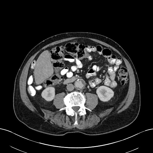 File:Active lower gastrointestinal bleeding - diverticular (Radiopaedia 61203-69106 Axial C+ portal venous phase 69).jpg
