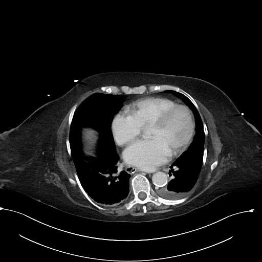 File:Active renal extravasation with large subcapsular and retroperitoneal hemorrhage (Radiopaedia 60975-68796 Axial 361).jpg