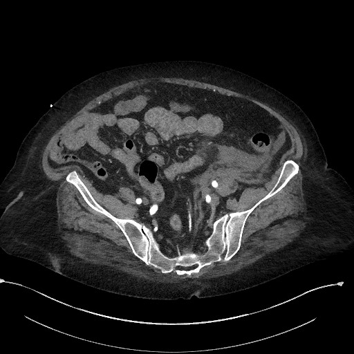 Active renal extravasation with large subcapsular and retroperitoneal hemorrhage (Radiopaedia 60975-68796 Axial C+ arterial phase 146).jpg