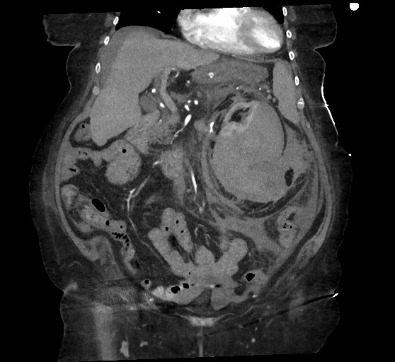 Active renal extravasation with large subcapsular and retroperitoneal hemorrhage (Radiopaedia 60975-68796 Coronal C+ arterial phase 64).jpg