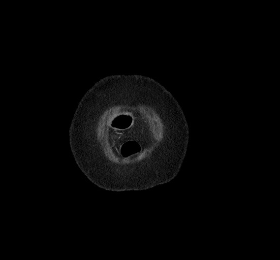 Active renal extravasation with large subcapsular and retroperitoneal hemorrhage (Radiopaedia 60975-68796 Coronal C+ portal venous phase 13).jpg
