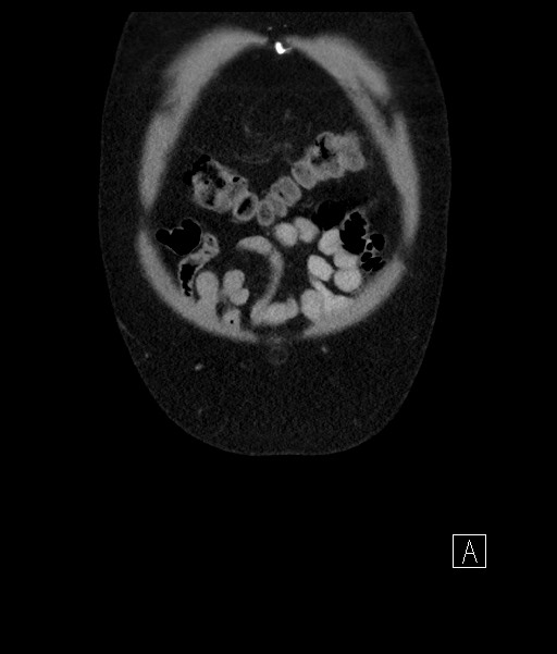 Acute-on-chronic pancreatitis (Radiopaedia 67286-76656 Coronal C+ portal venous phase 13).jpg